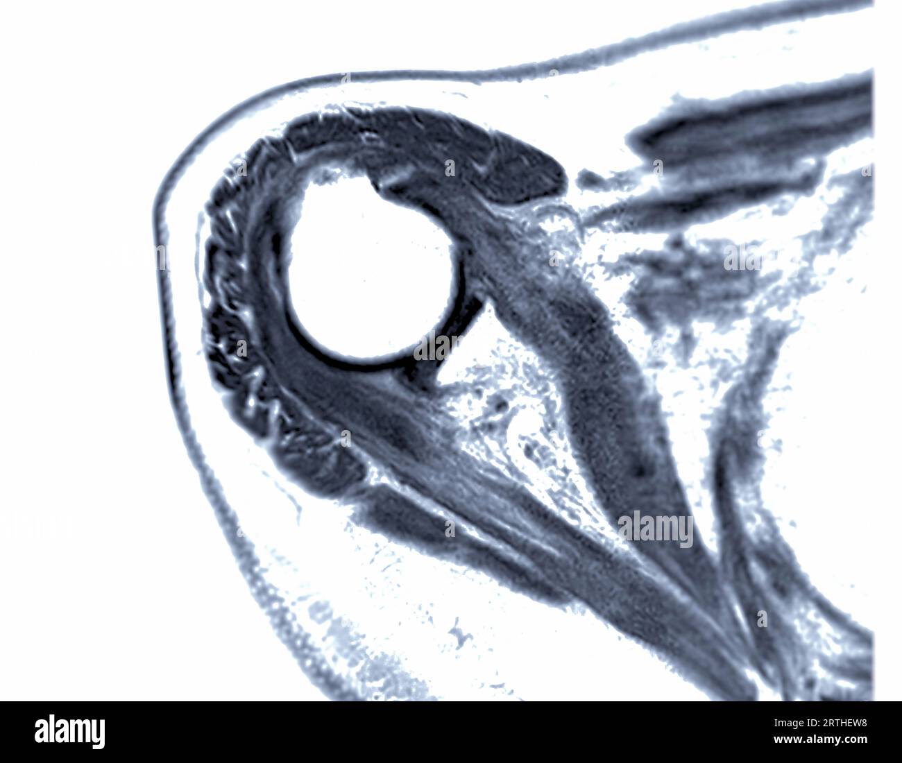 Resonance Imaging or MRI of Shoulder Joint for diagnostic shoulder pain Stock Photo Alamy