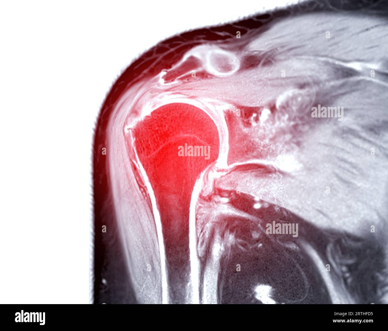Resonance Imaging or MRI of Shoulder Joint for diagnostic shoulder pain Stock Photo Alamy