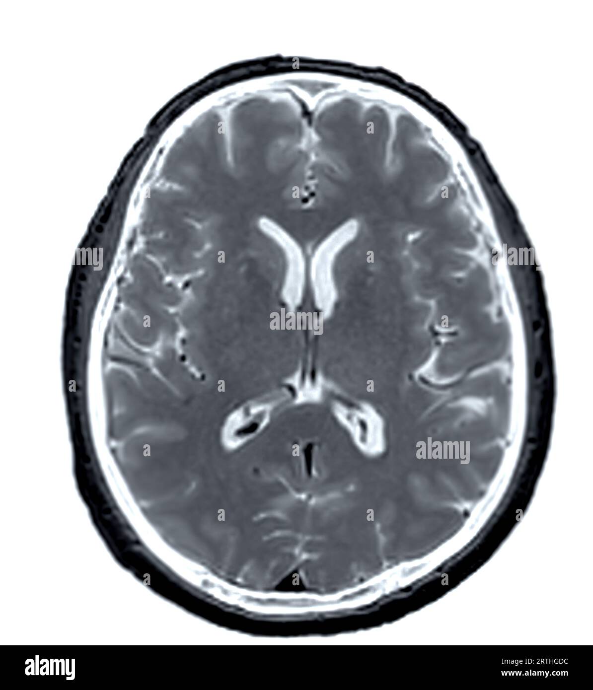 MRI  brain scan  axial view for detect  Brain  diseases sush as stroke disease, Brain tumors and Infections. Stock Photo