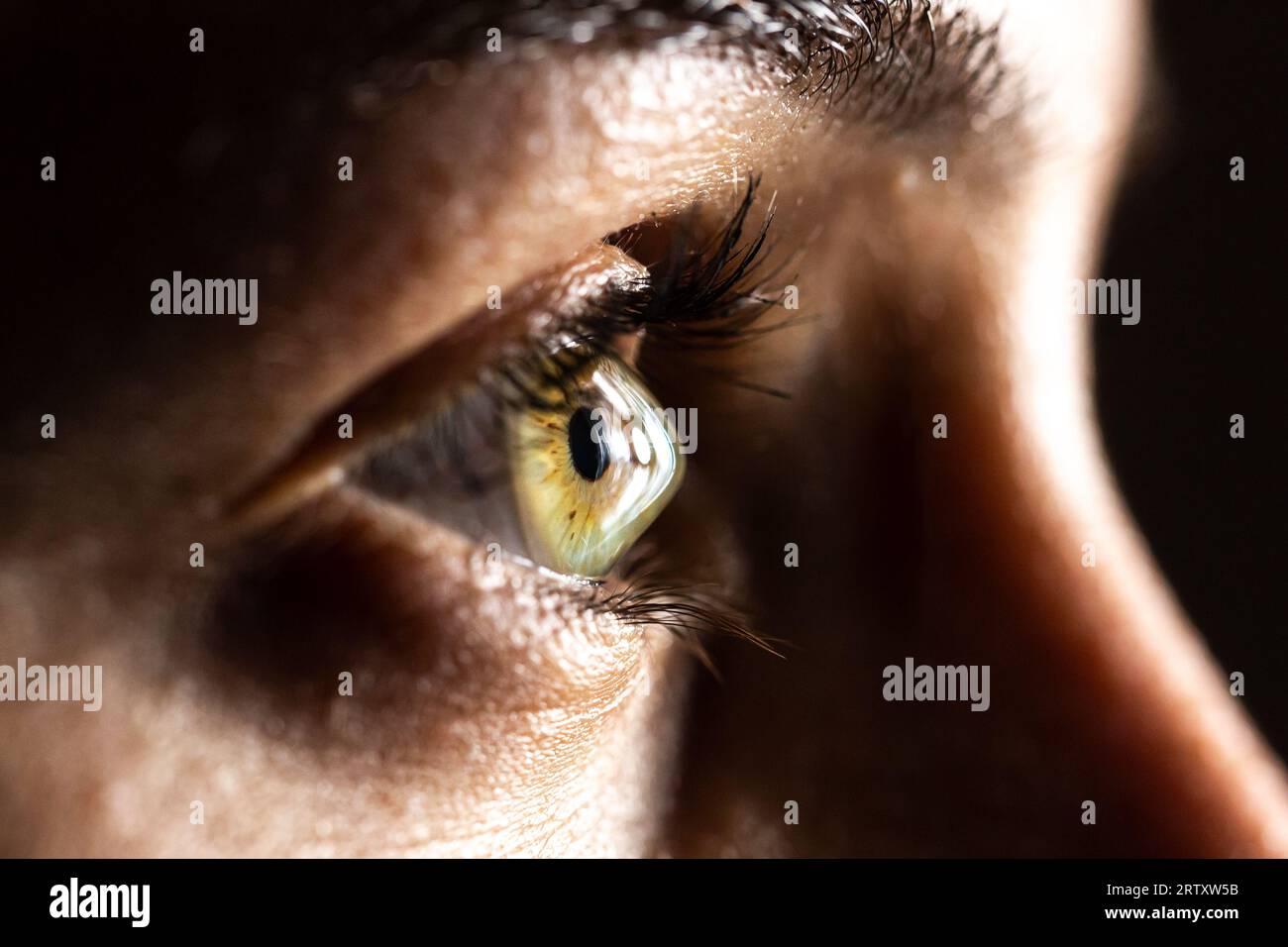 Macro of a clear female eye of a Caucasian woman suffering from keratoconus. A cone-shaped deformation of the cornea Stock Photo