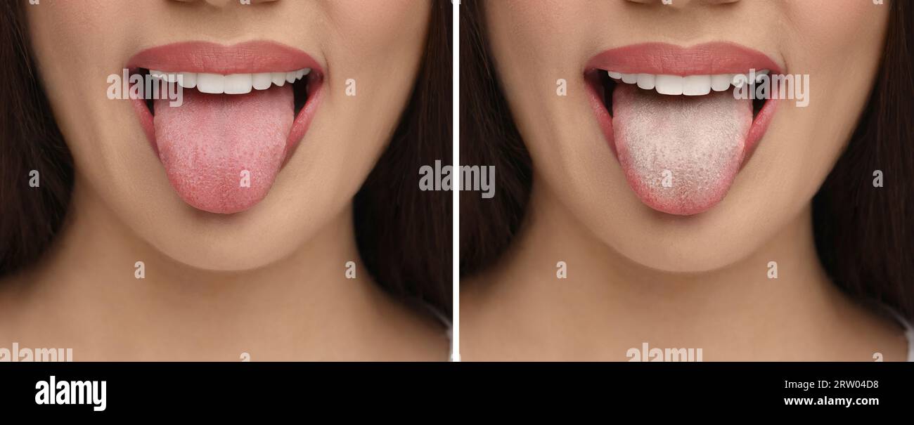 Collage with photos of woman before and after tongue cleaning, closeup Stock Photo