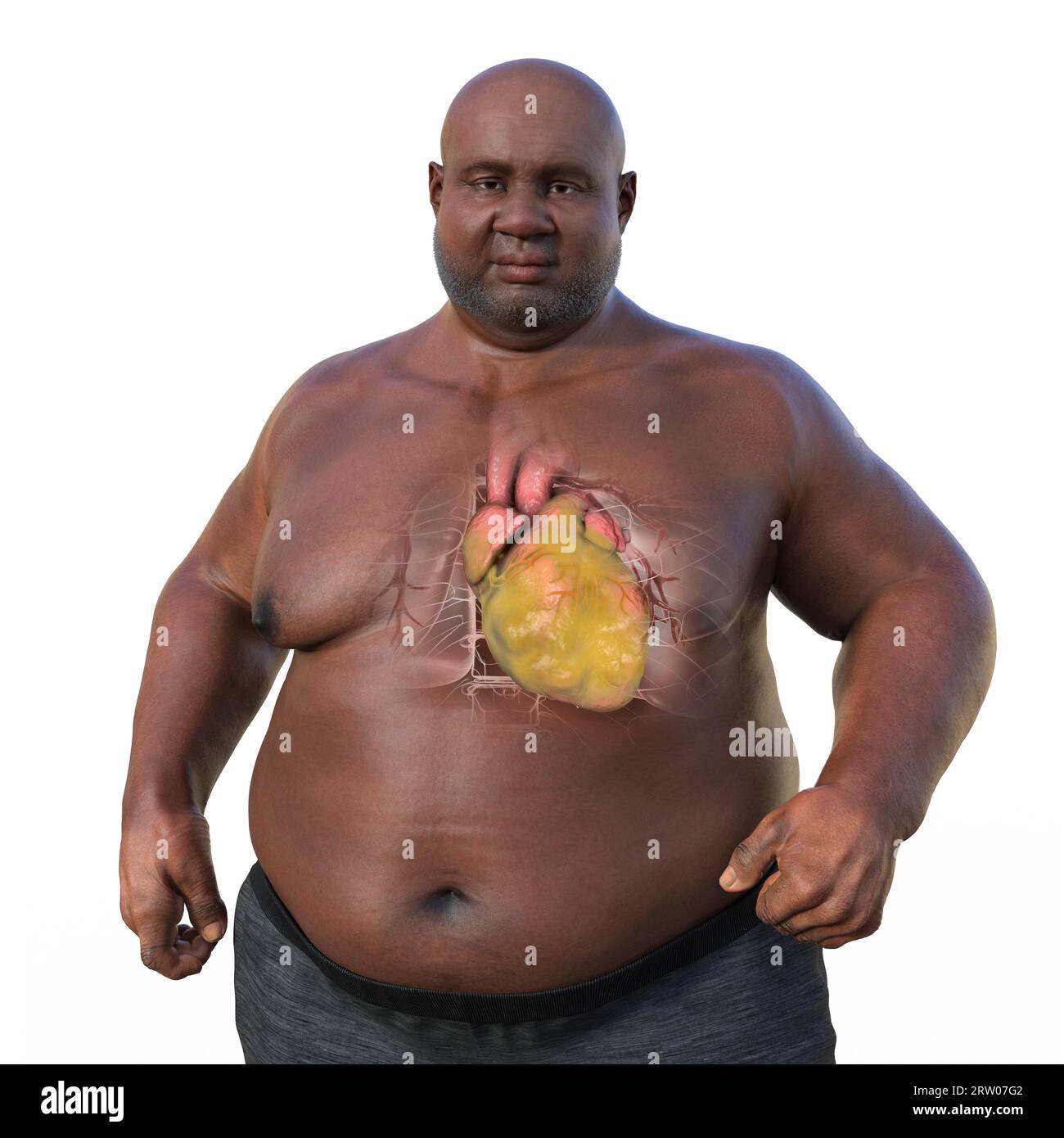 Overweight man with enlarged heart, illustration Stock Photo