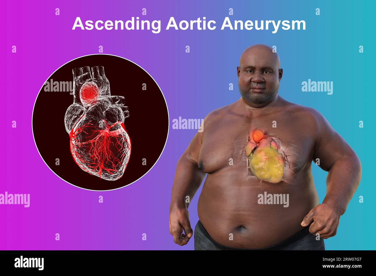 Obese man with ascending aortic aneurysm, illustration Stock Photo Alamy