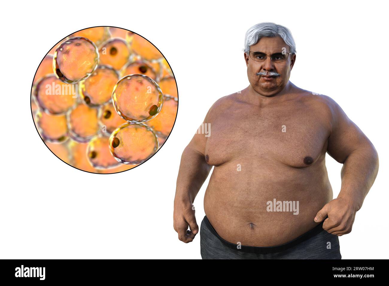 Overweight man with adipocytes, illustration Stock Photo