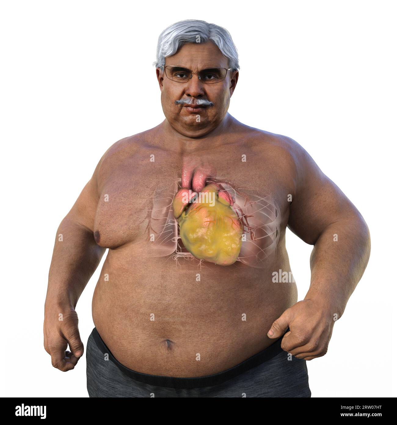 Overweight man with enlarged heart, illustration Stock Photo