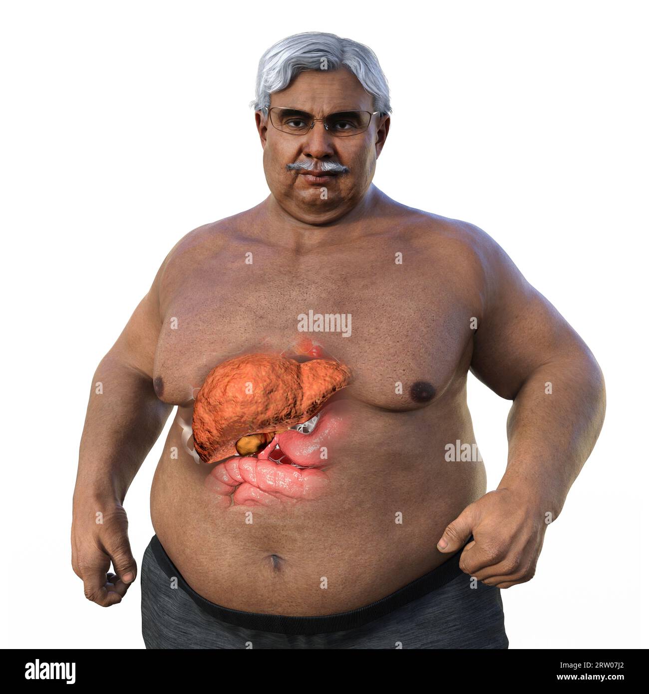 Overweight man with steatosis, illustration Stock Photo Alamy