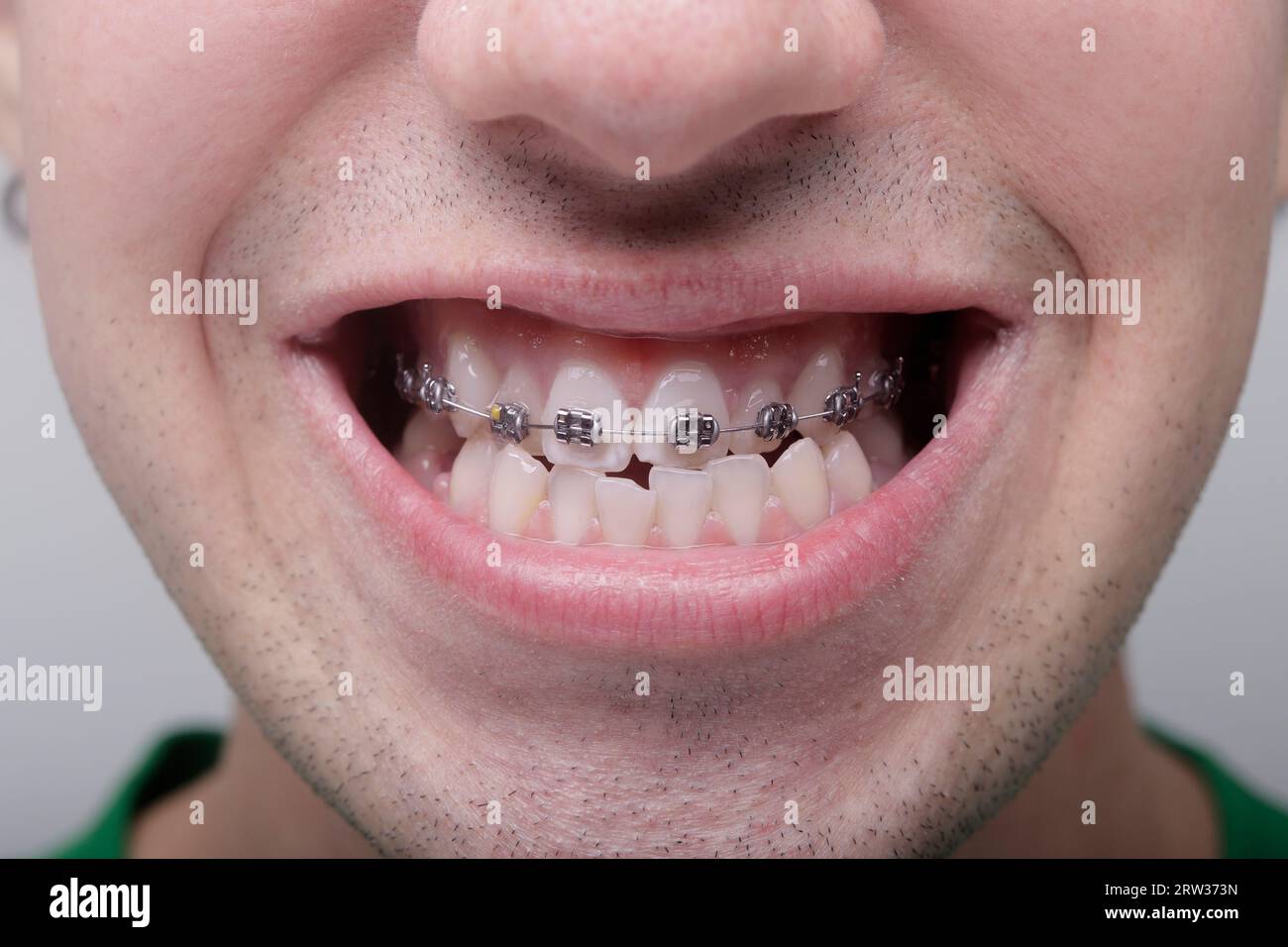 boy's mouth with brackets at the top Stock Photo