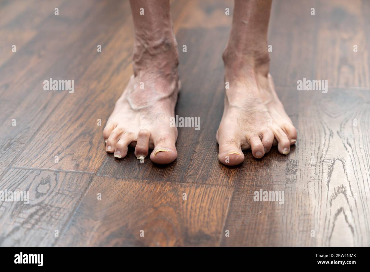 Man's deformed hammertoes showing left foot one year after surgery Stock Photo