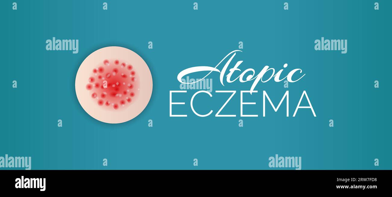 Skin eczema Stock Vector Images Alamy