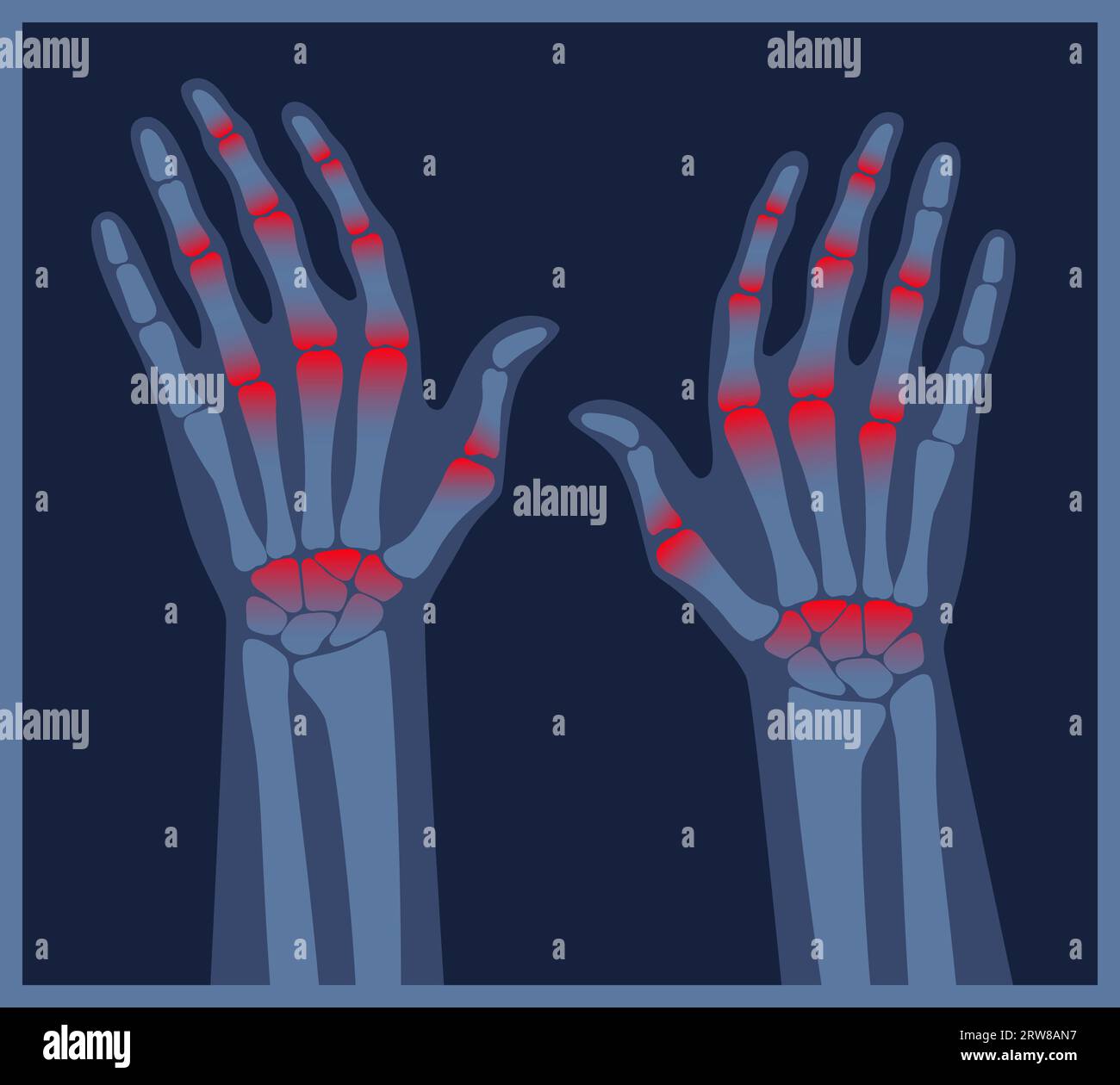 Arthritis hands x-ray. Pain in the human body. Arthritis, bone disease ...