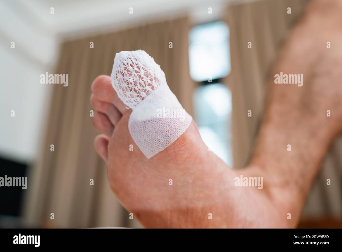an injured toe with net bandage 2RW9E2D
