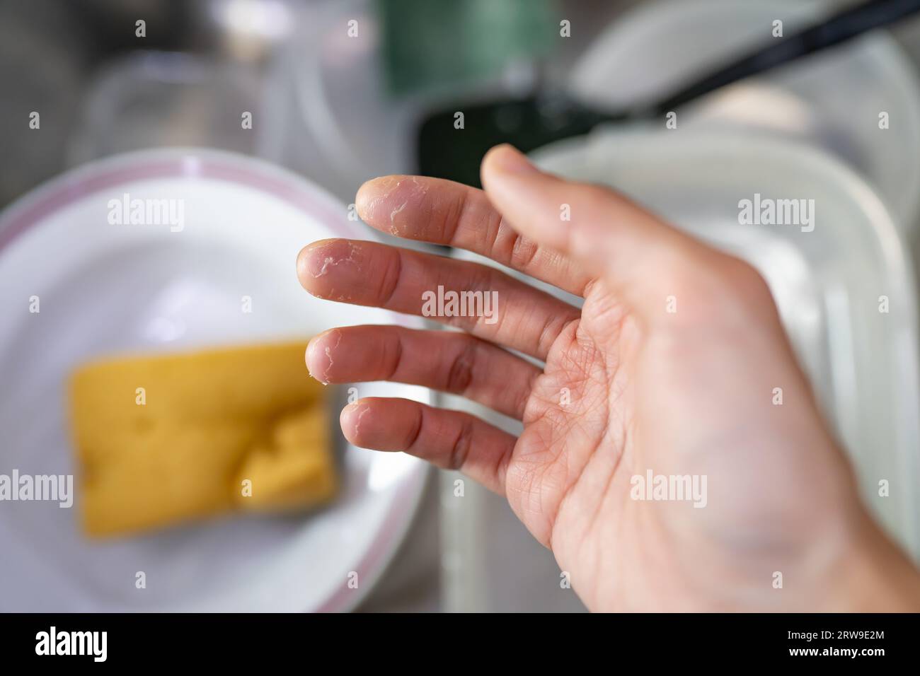 Hand with peeling skin because of dish washing Stock Photo Alamy