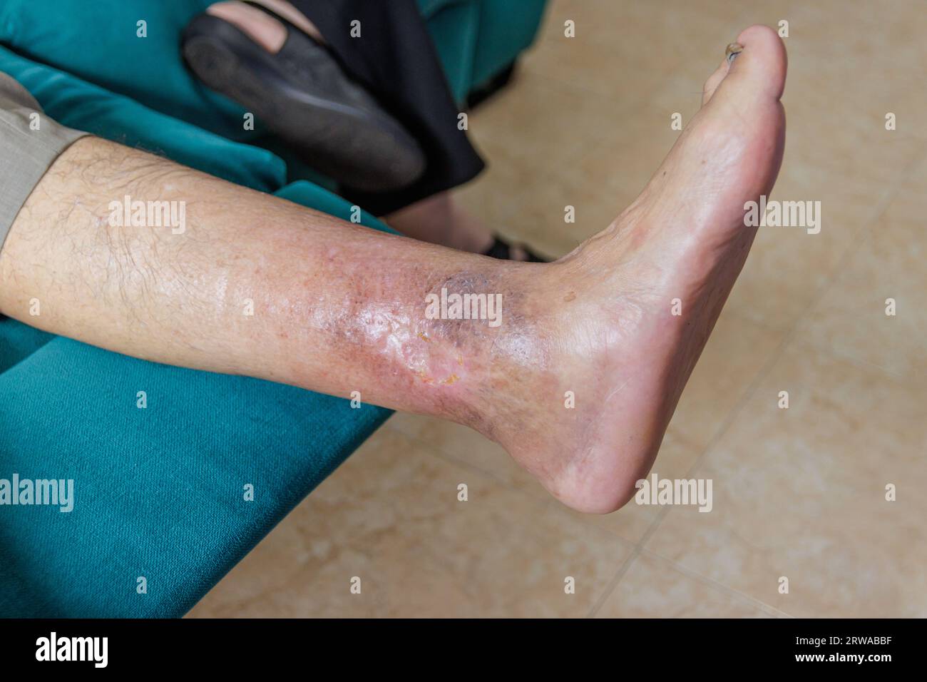 Leg senior person with ulcer due to diabetes Stock Photo