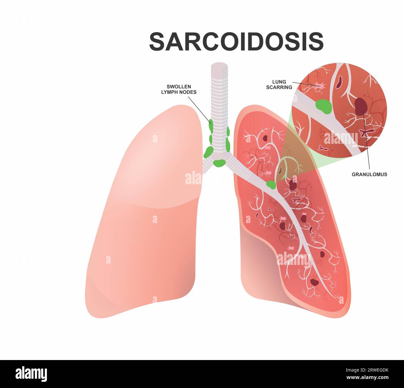 Sarcoidosis Illustration lung disease Stock Photo