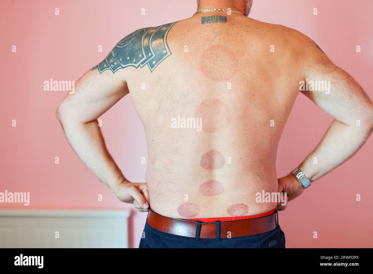 marks on the male back from cupping massage Stock Photo