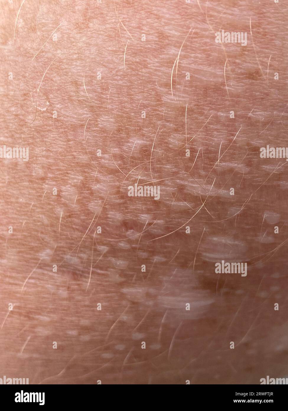 Close up on blistered skin damaged by sun exposure. Stock Photo