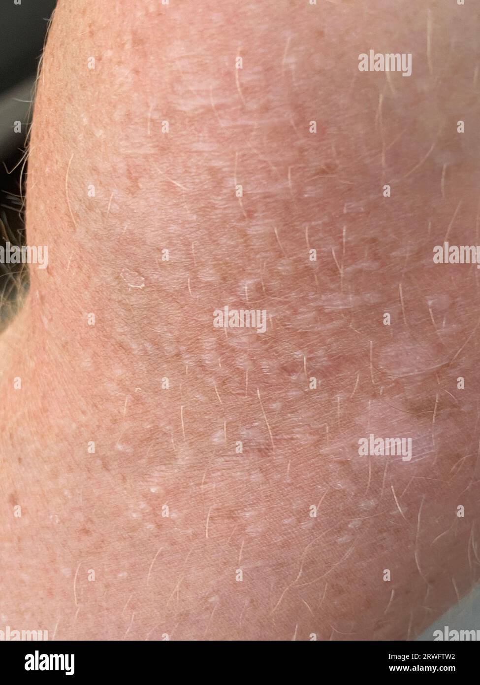 Close up on blistered skin damaged by sun exposure. Stock Photo