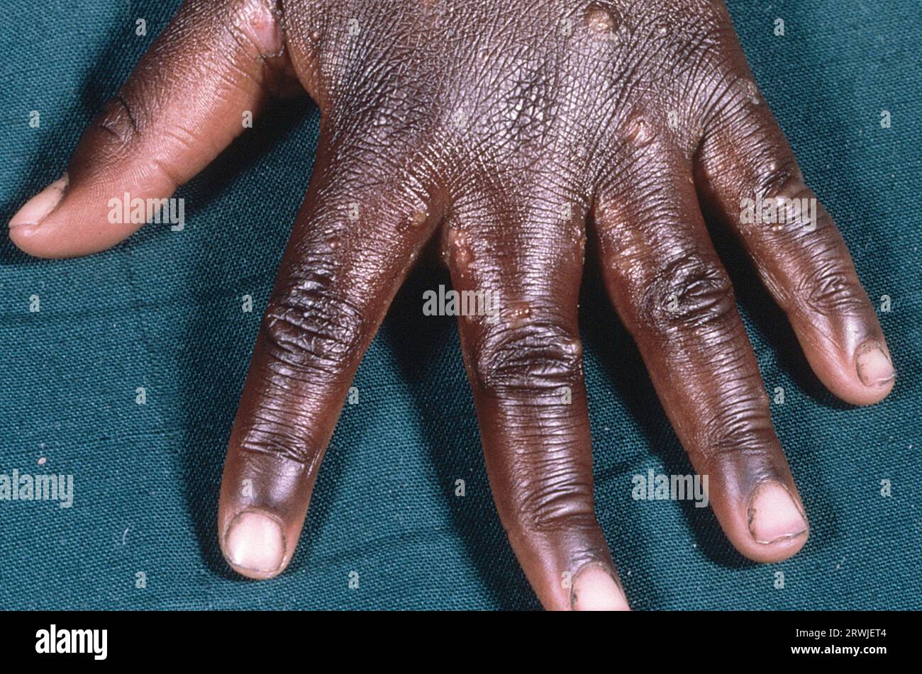 Scabies infection on the skin Stock Photo Alamy