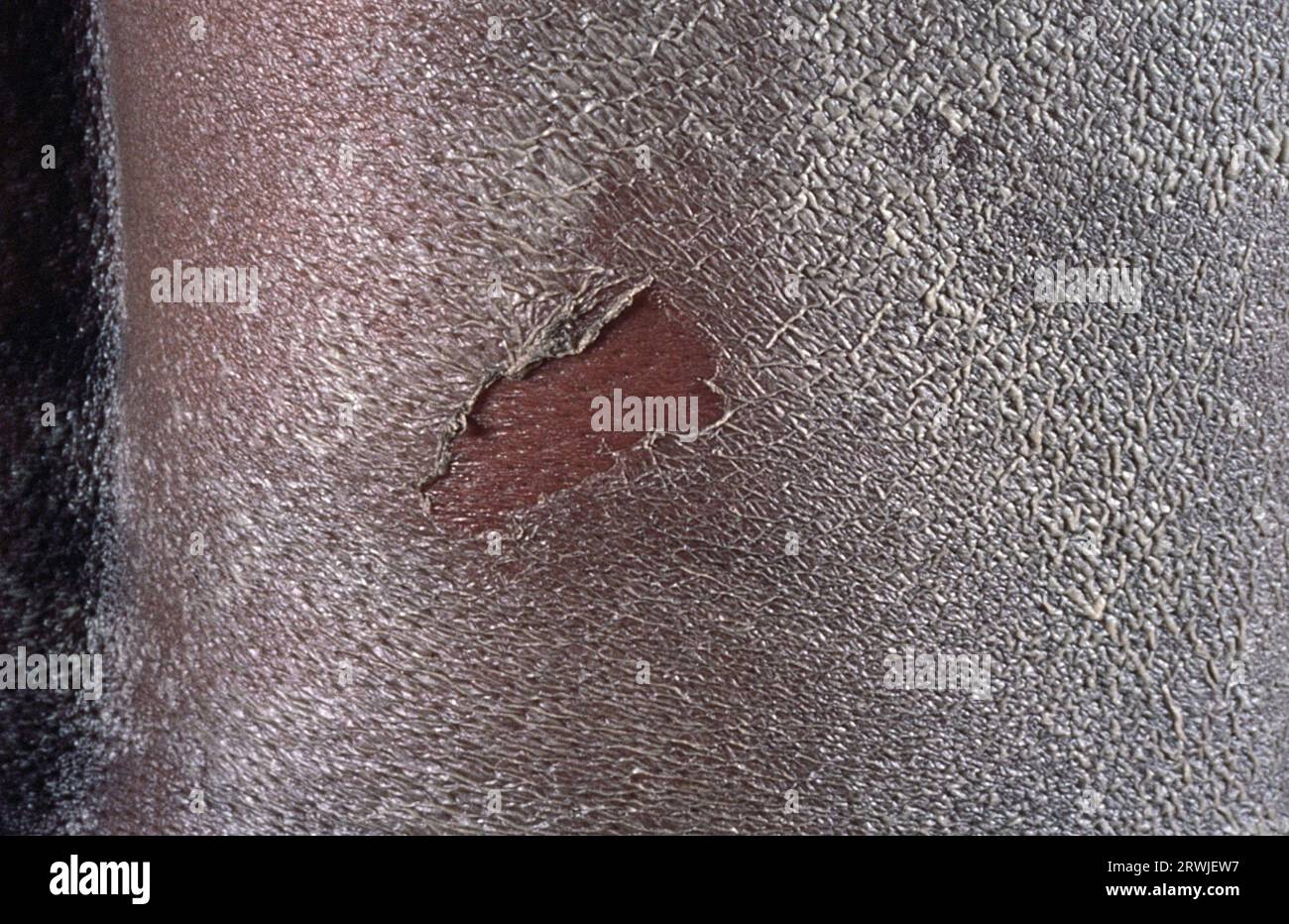 Toxic epidermal necrolysis Stock Photo - Alamy