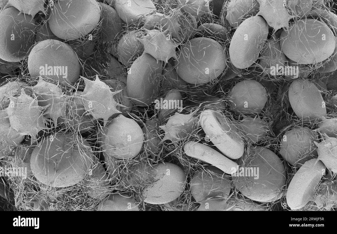 Blood Clot Illustration Stock Photo Alamy Blood Clot Illustration Stock Photo Alamy