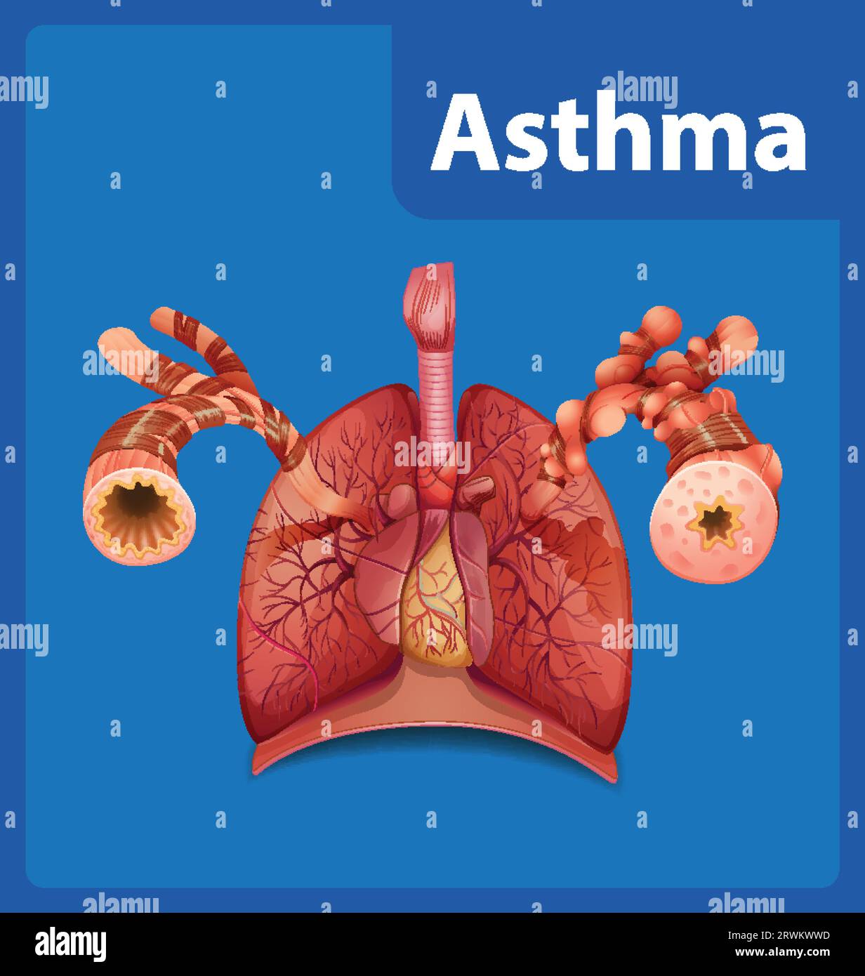 Illustrated infographic comparing normal and asthma lungs in medical education Stock Vector