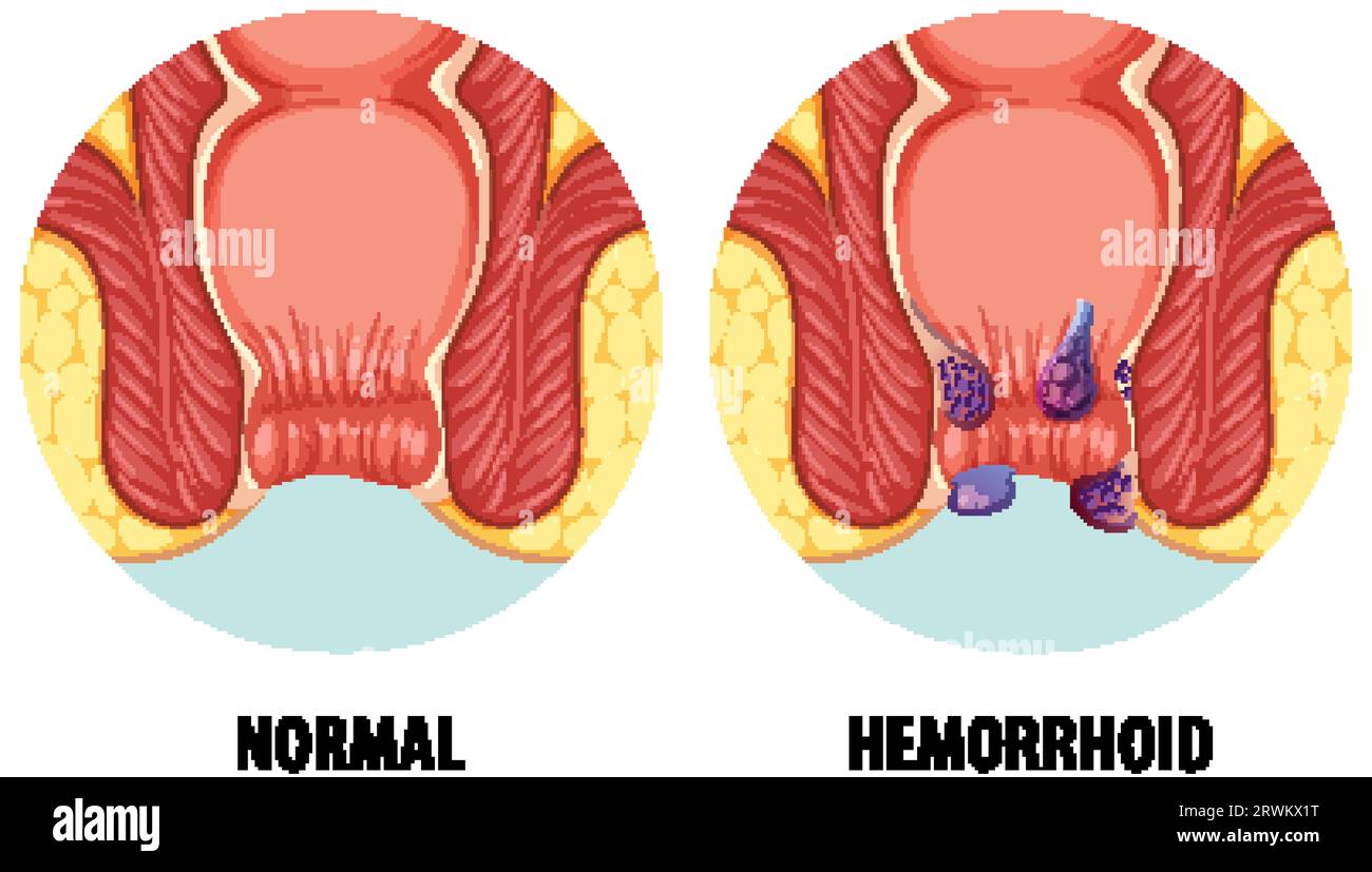 Illustration comparing normal anatomy with hemorrhoid condition Stock Vector