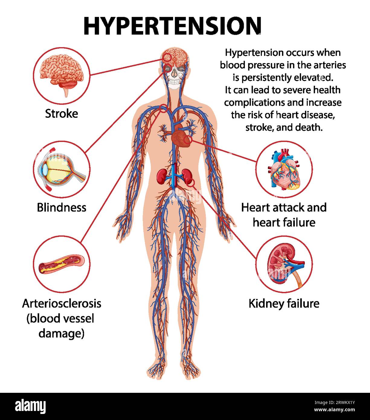 Illustrated infographic explaining how hypertension impacts various parts of the human body Stock Vector