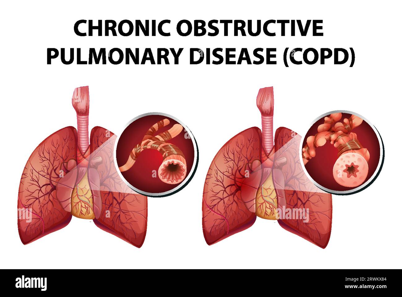 Illustration depicting the medical aspects of chronic obstructive ...