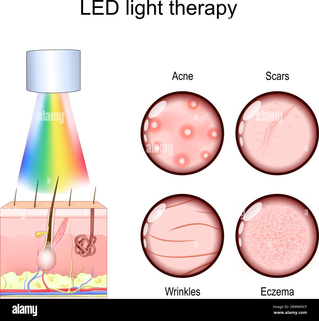 LED light therapy for skin-related issues, like Acne treatment, Scars, and Wrinkles reduction, and Eczema management. Phototherapy for Skin rejuvenati Stock Vector