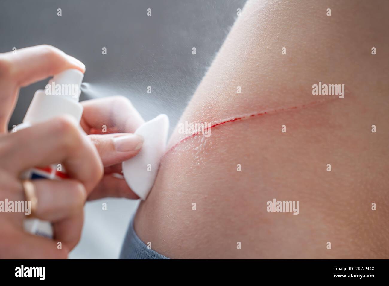 spray antiseptic on the wound on the child's back. disinfection of