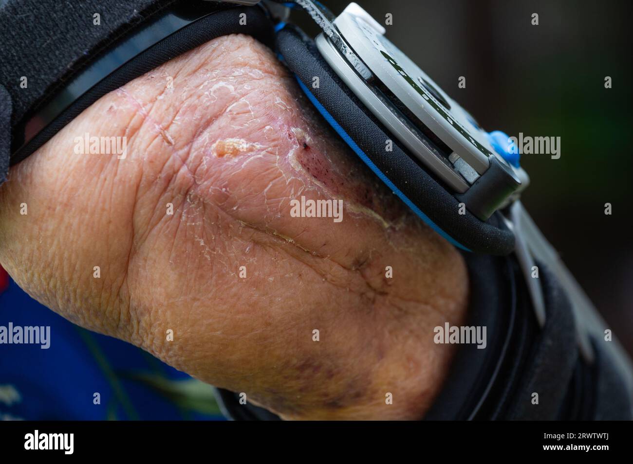 Woman wearing Post-Op Elbow Brace after breaking her elbow & having surgery. Closeup showing scar. Stock Photo