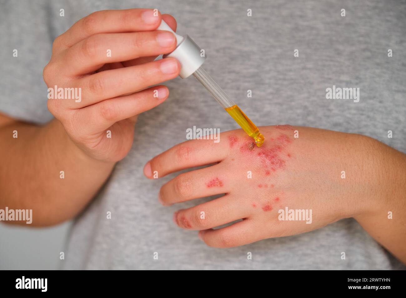 Patient hands applying rosehip oil on eczema. Stock Photo