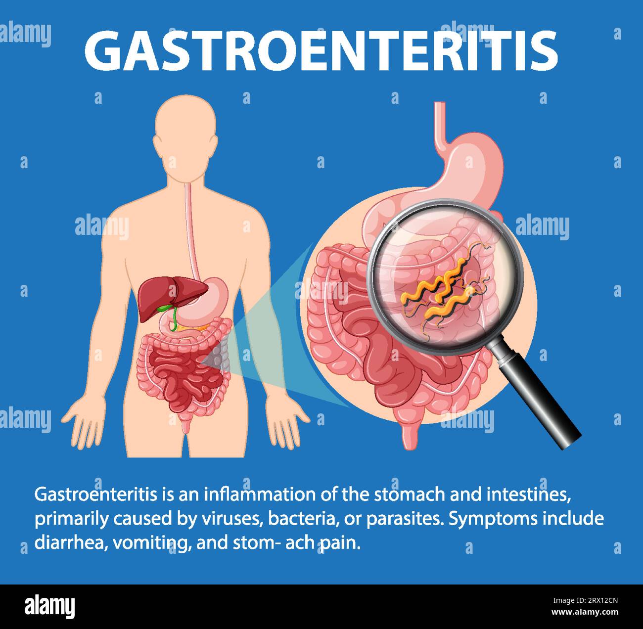 An infographic illustrating the causes and symptoms of gastroenteritis