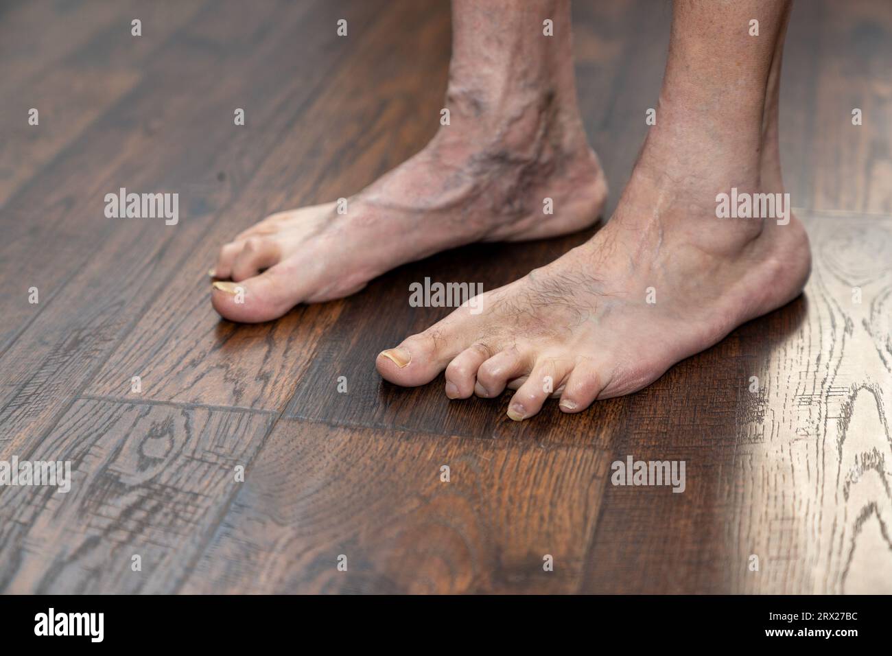 Deformed Feet From Heels