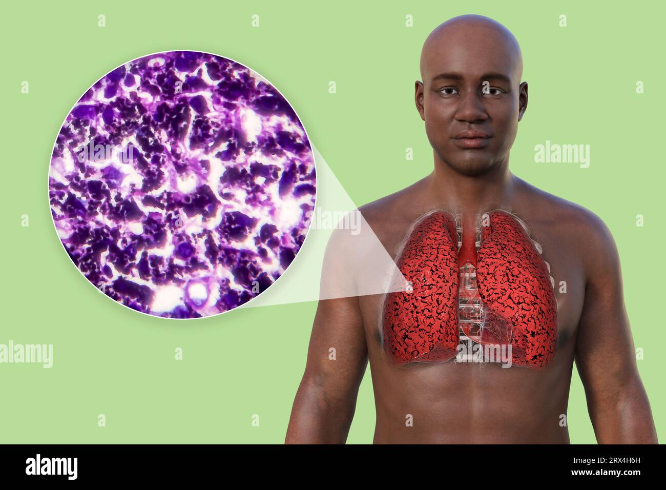 Smoker's lungs, illustration Stock Photo Alamy