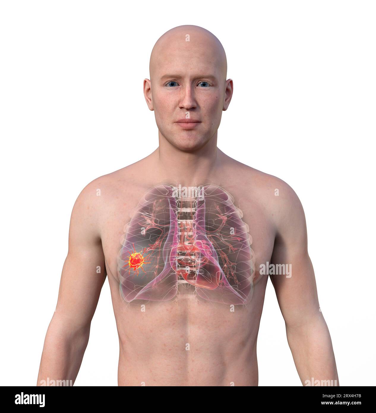 Lung cancer, illustration Stock Photo - Alamy
