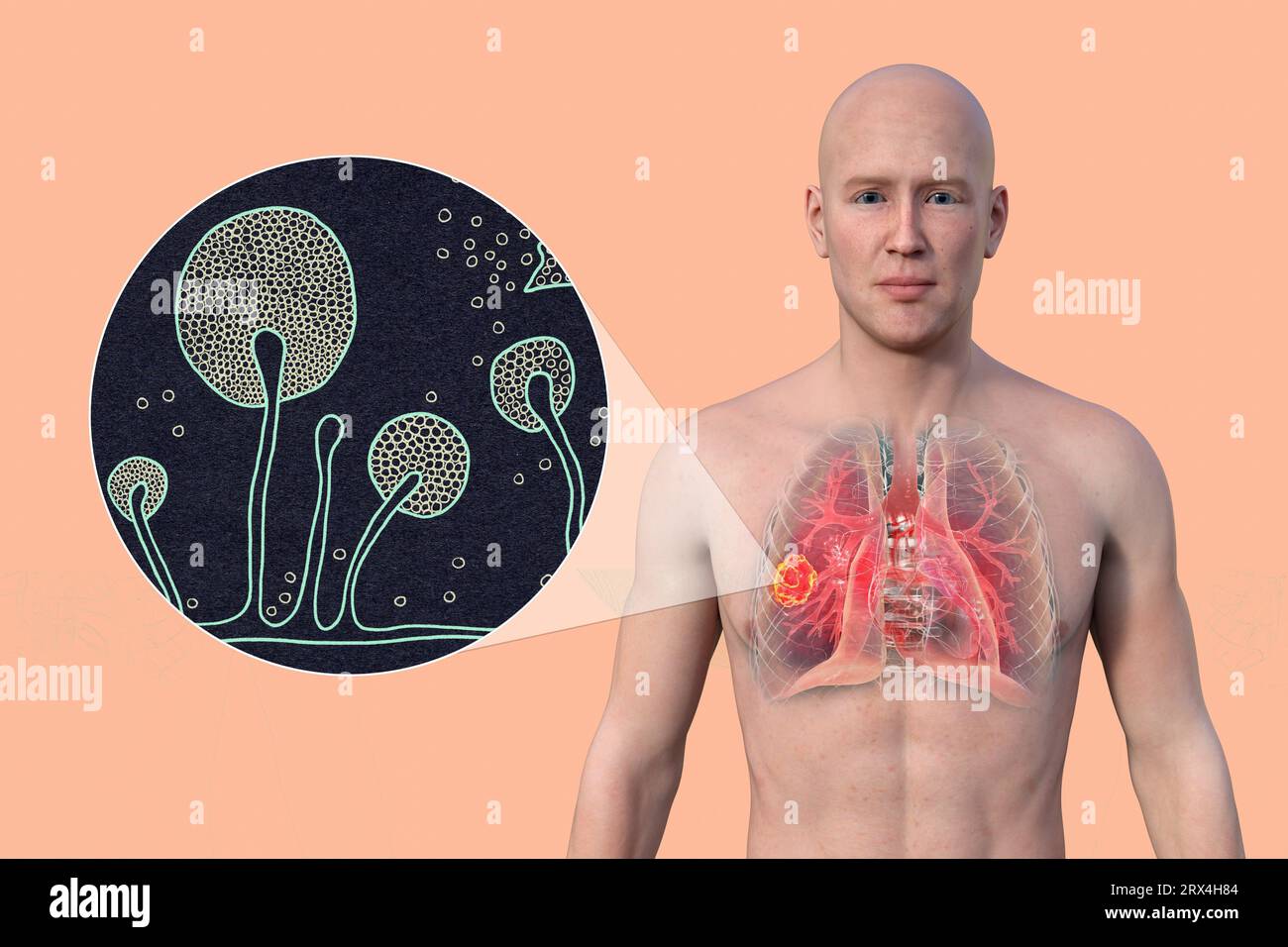 Lung mucormycosis lesion, illustration Stock Photo