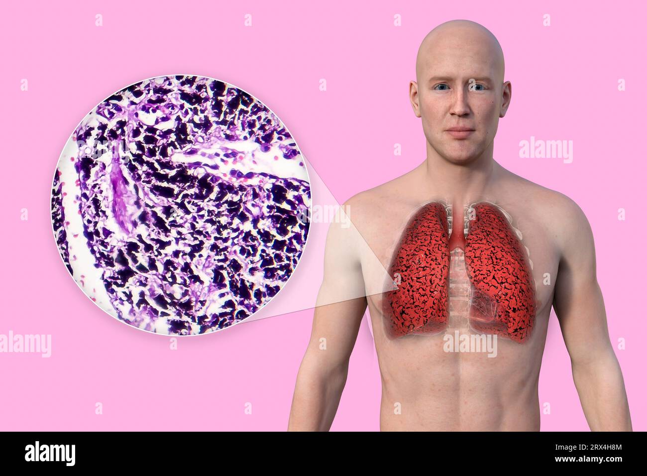 Smoker's lungs, illustration Stock Photo Alamy