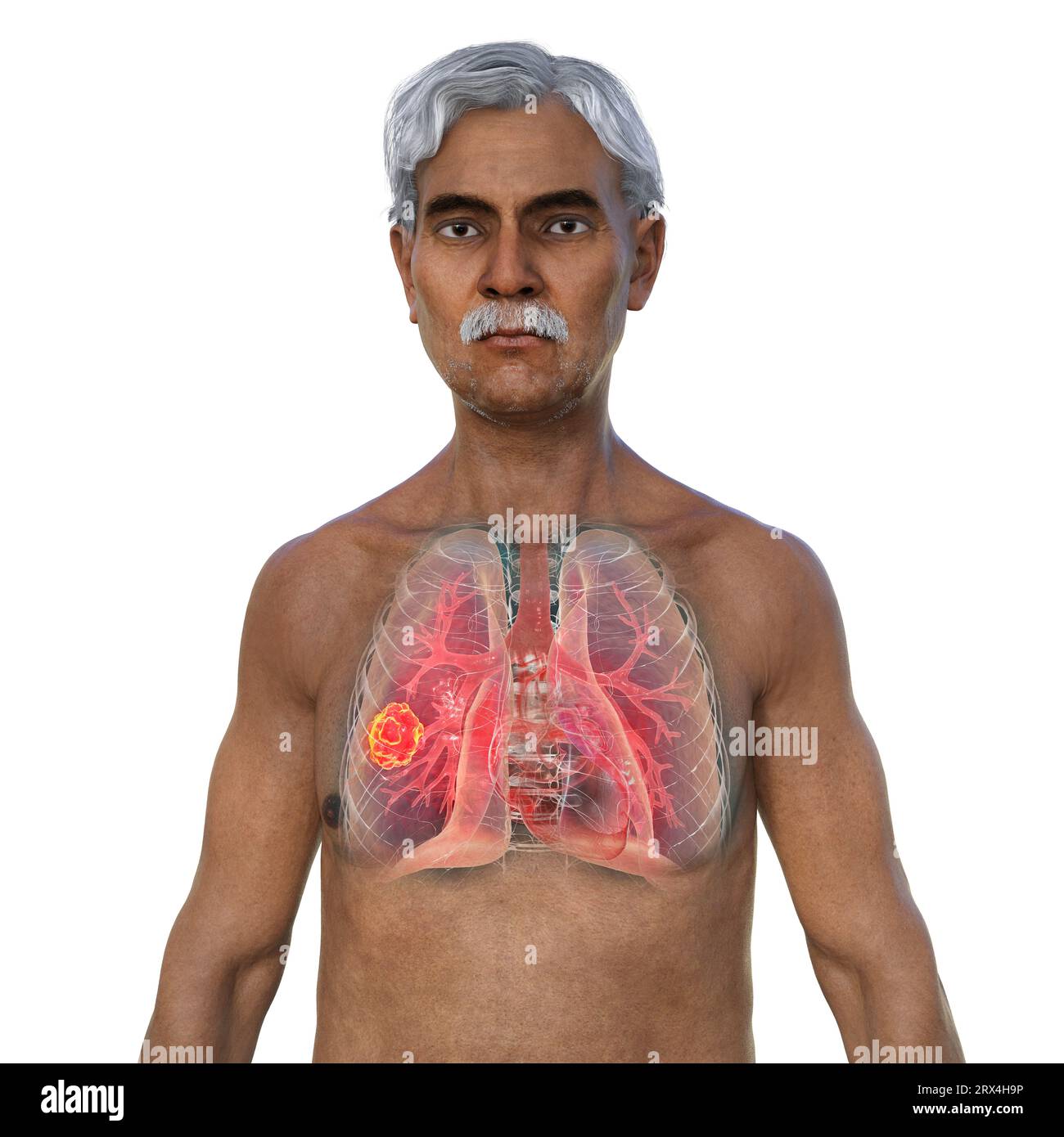 Lung mucormycosis lesion, illustration Stock Photo