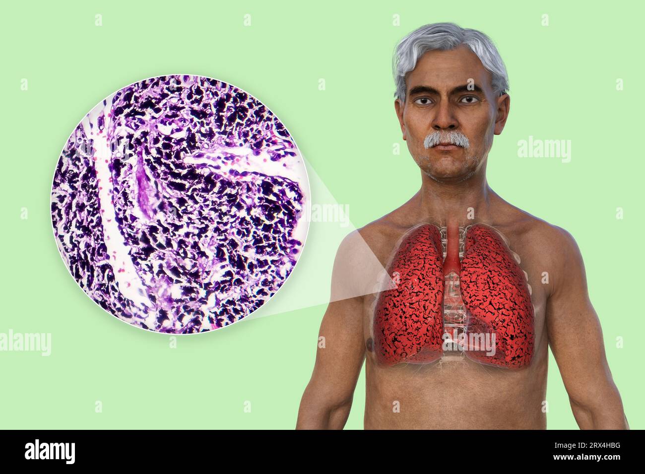 Smoker's lungs, illustration Stock Photo Alamy