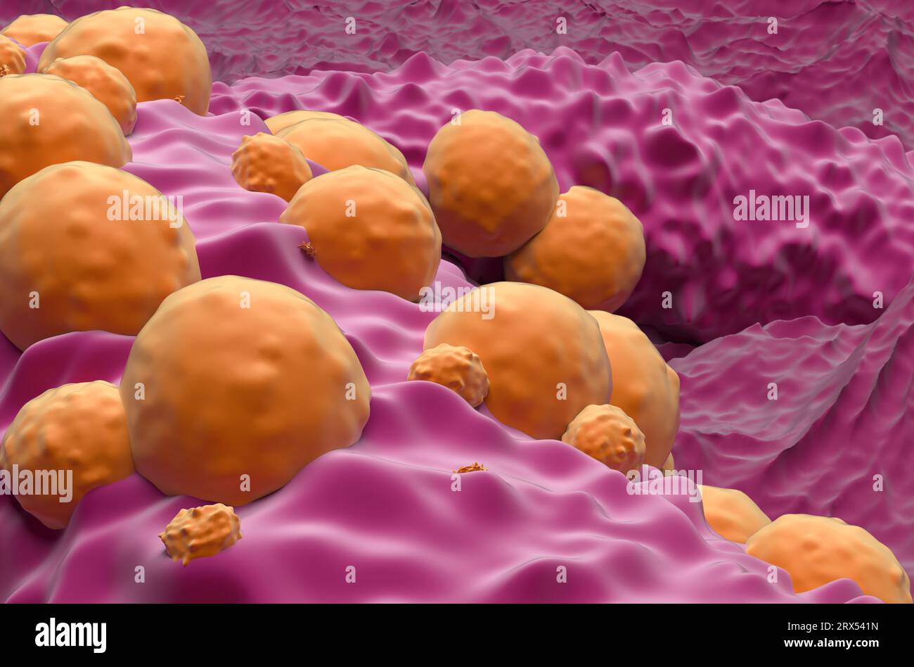 Basal-cell carcinoma (BCC) - closeup view 3d illustration Stock Photo ...