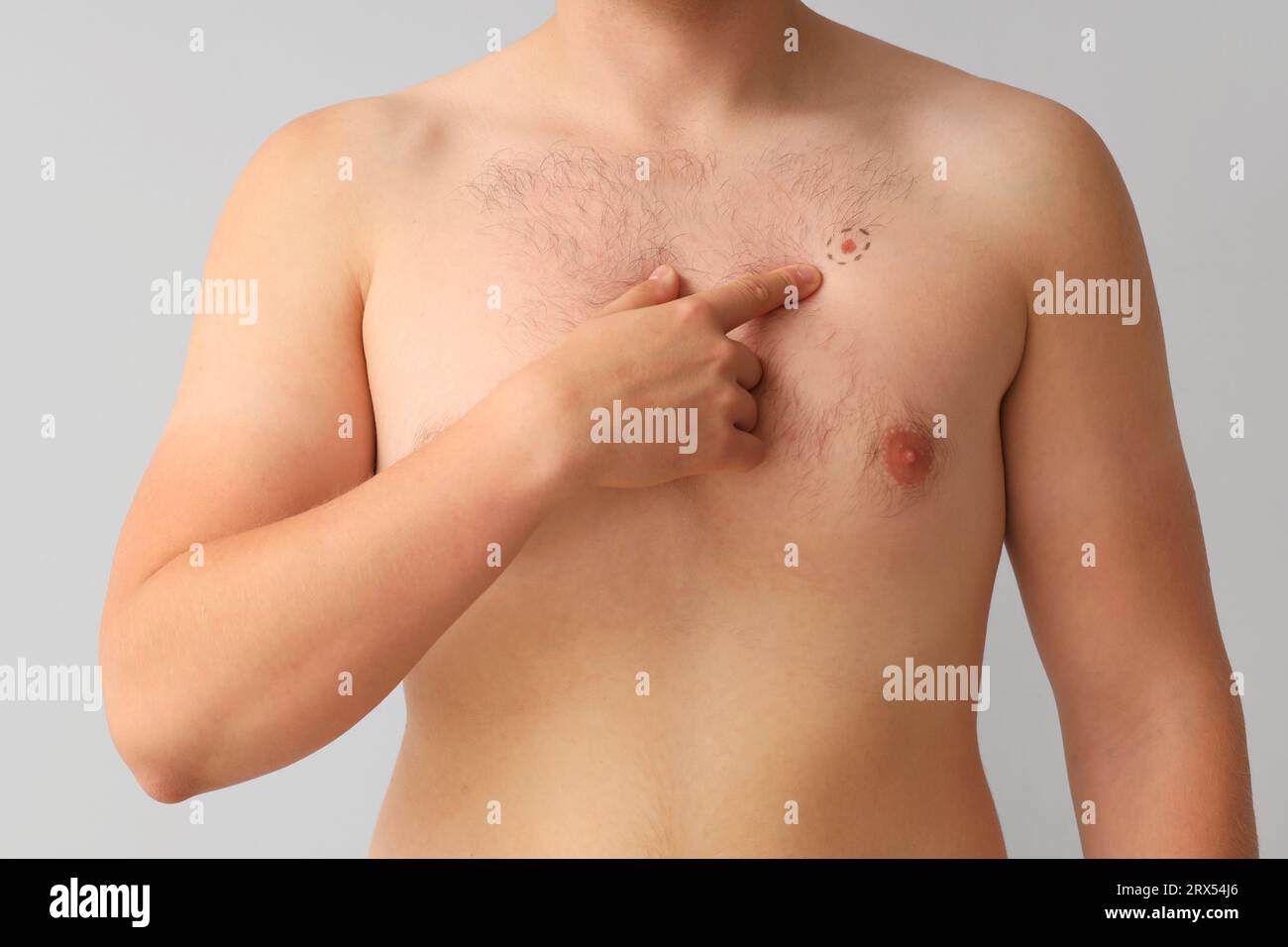 Young man pointing at marked mole on his chest against light background,  closeup Stock Photo - Alamy