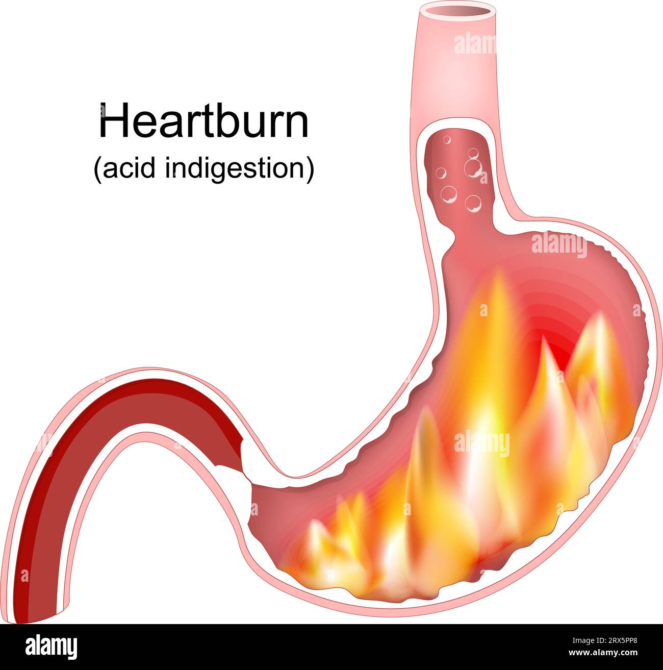 Heartburn. Cross section of a stomach with flame. Pyrosis, cardialgia or acid indigestion. burning sensation in the stomach. Gastroesophageal reflux d Stock Vector