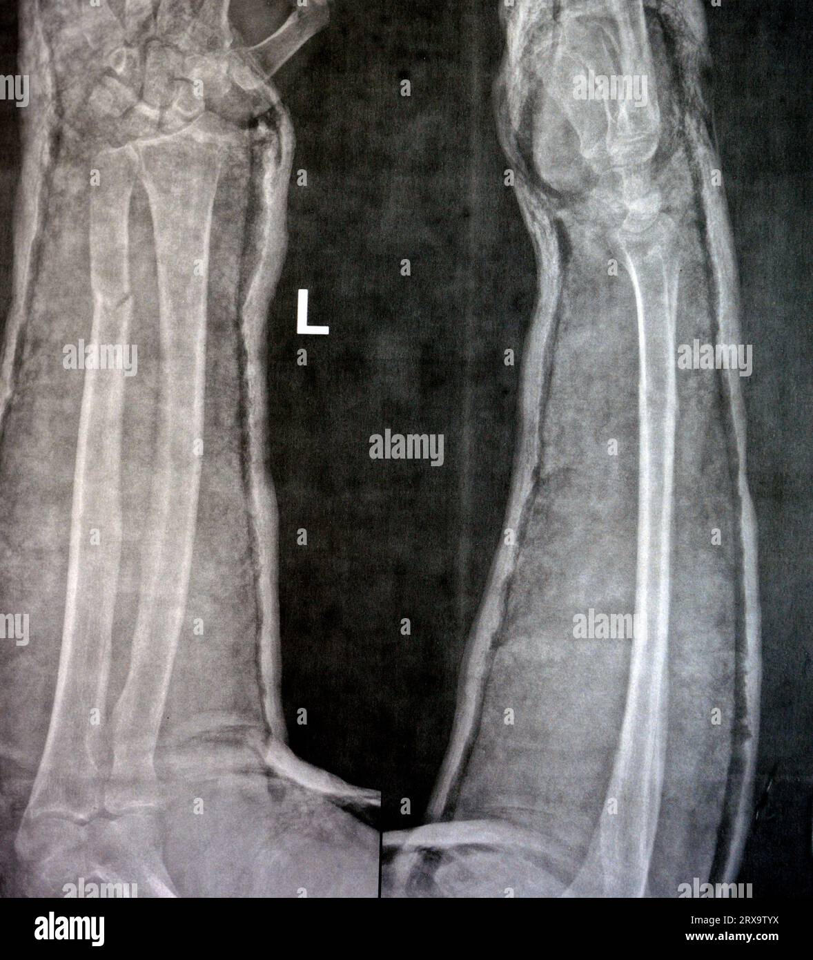 Plain X ray of right forearm (mistakenly written Left on the film