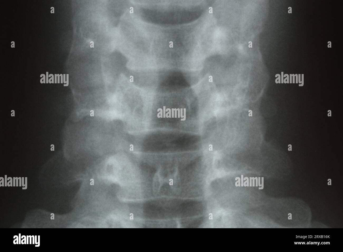 Cervical spine hi-res stock photography and images - Alamy