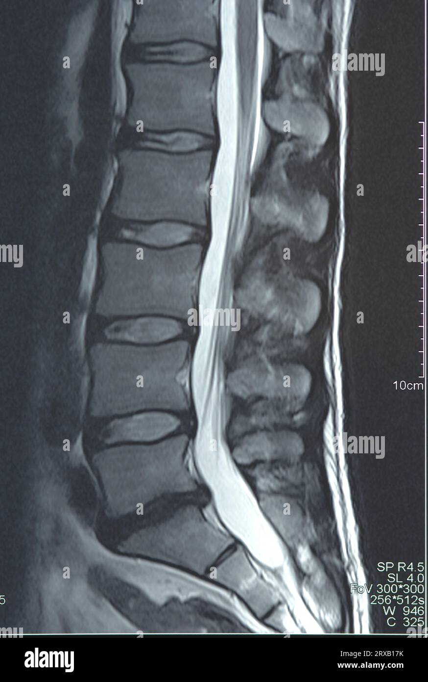Magnetic resonance image of the lumbar spine Stock Photo - Alamy