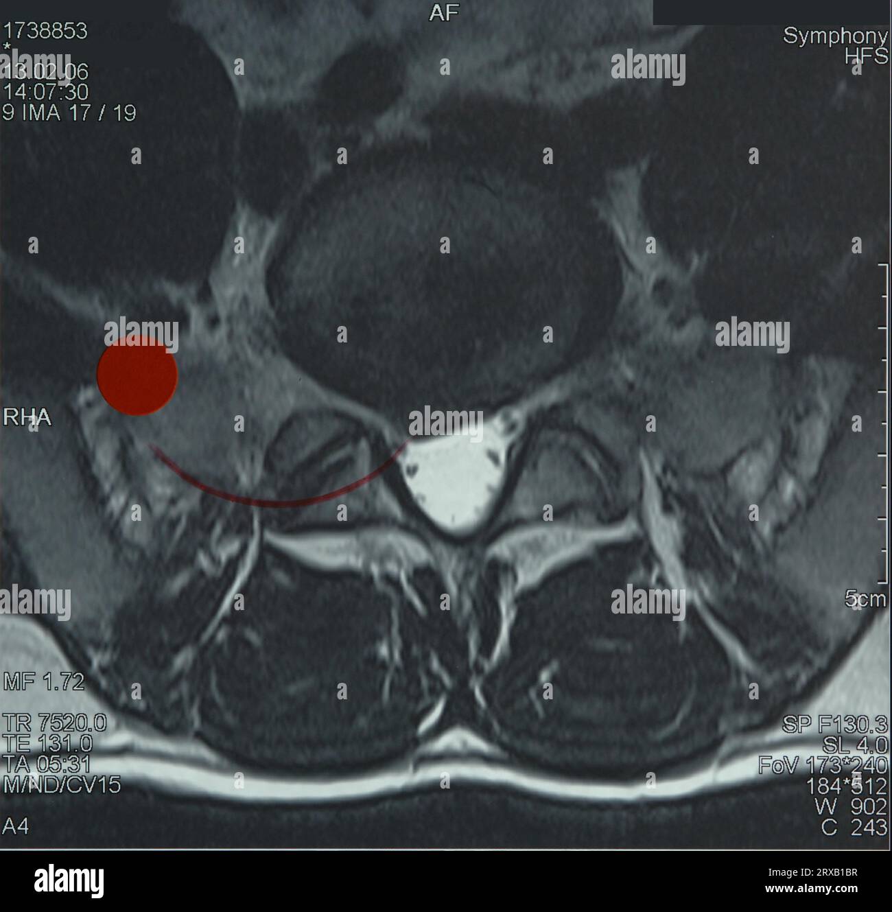 Magnetic resonance image of the lumbar spine Stock Photo - Alamy