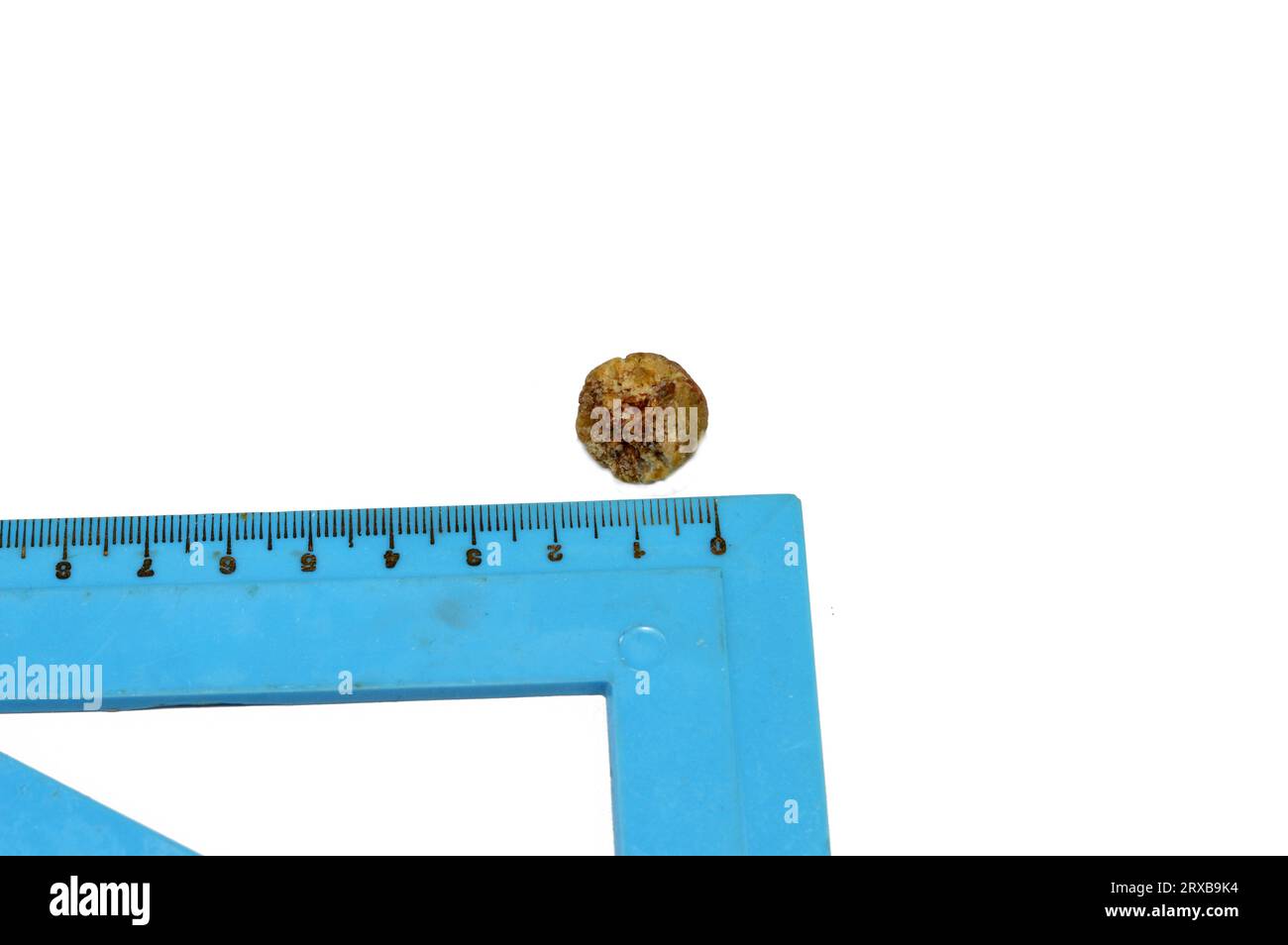 Large gallstone removed surgically after laparoscopic cholecystectomy