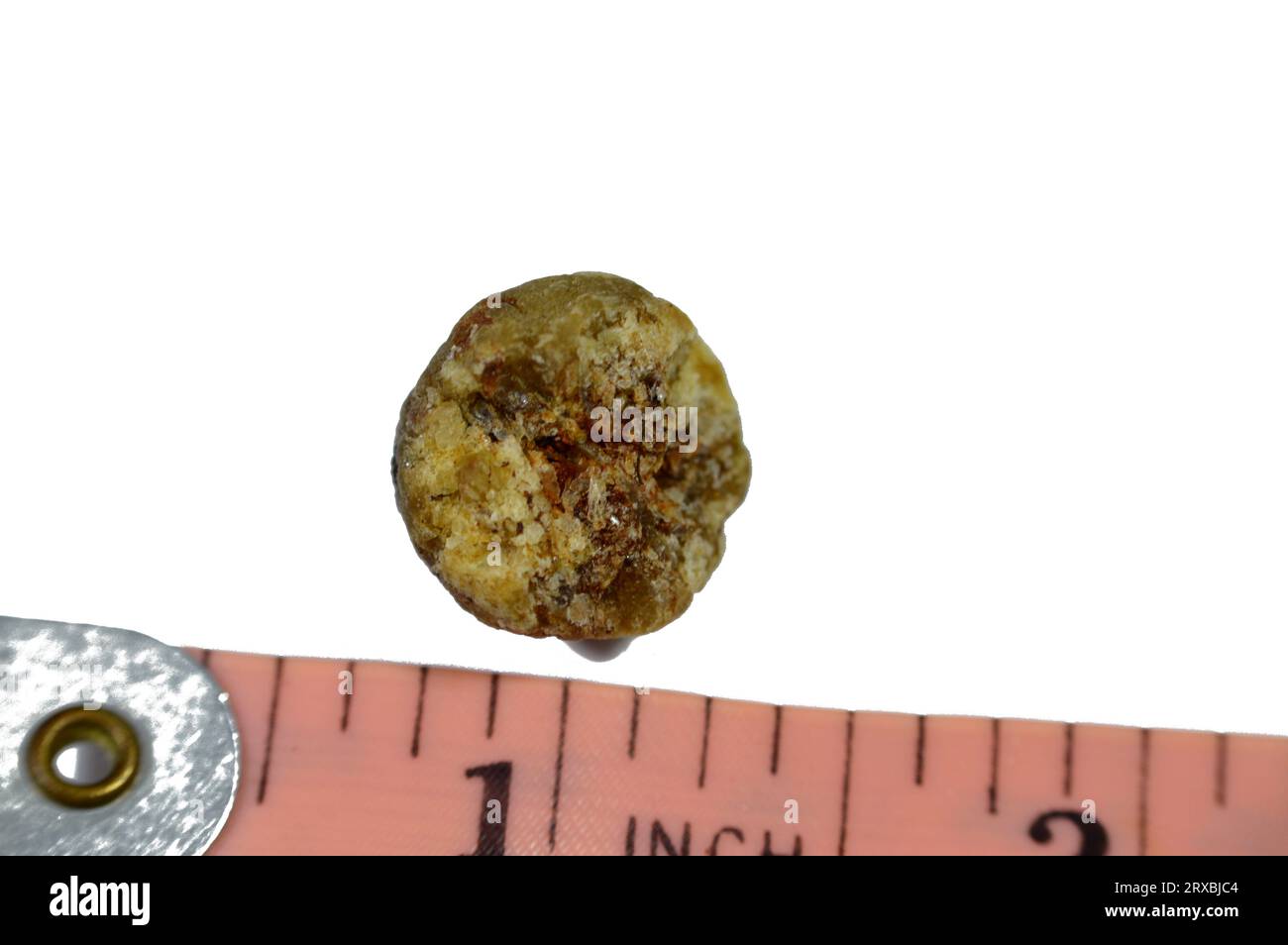 Large gallstone removed surgically after laparoscopic cholecystectomy, Gallstones are hardened deposits of digestive fluid that can form in gallbladde Stock Photo