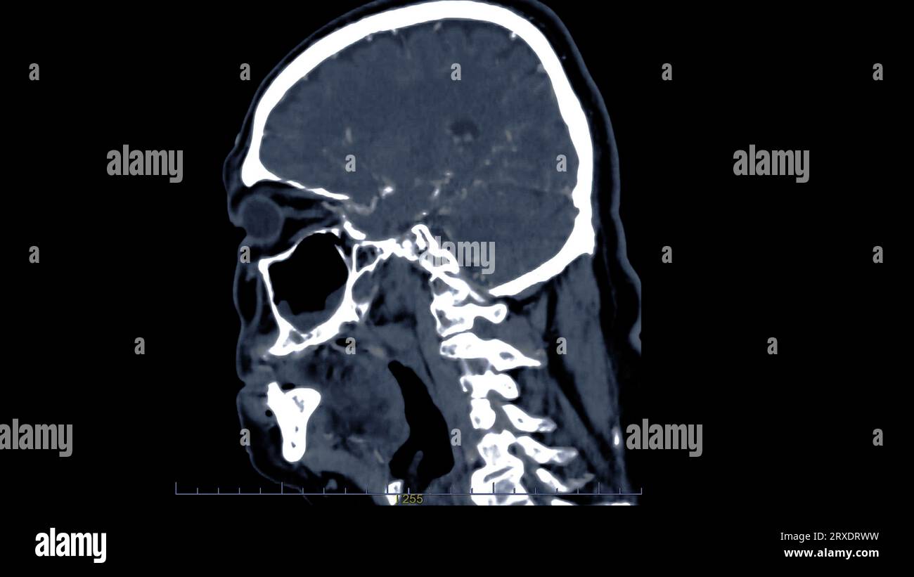 CT scan of the brain with injection contrast media  for diagnosis brain tumor,stroke diseases and vascular diseases. Stock Photo